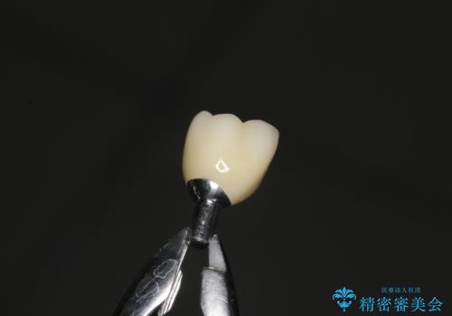 歯周病にて保存不可能な歯をショートインプラントで回復する
