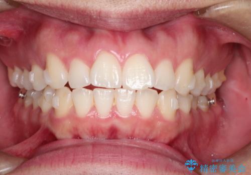 インビザラインで前歯のがたつきを目立たずに矯正治療の治療中