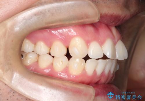 インビザラインで前歯のがたつきを目立たずに矯正治療の治療中
