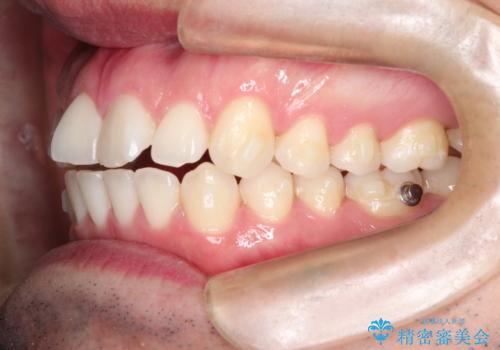 インビザラインで前歯のがたつきを目立たずに矯正治療の治療中