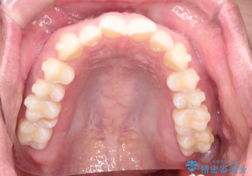 インビザラインで前歯のがたつきを目立たずに矯正治療の治療中