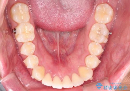 インビザラインで前歯のがたつきを目立たずに矯正治療の治療中