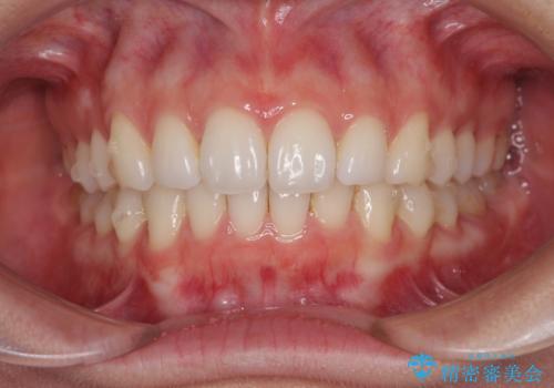 矯正治療の後戻りをインビザライン・ライトで改善の治療中