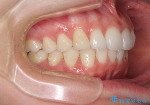 矯正治療の後戻りをインビザライン・ライトで改善の治療中