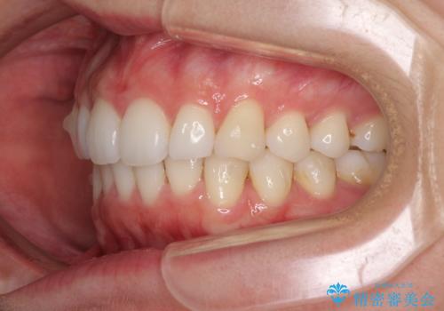 矯正治療の後戻りをインビザライン・ライトで改善の治療中