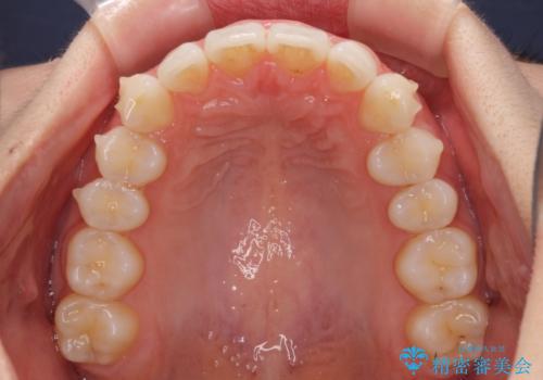 矯正治療の後戻りをインビザライン・ライトで改善の治療中