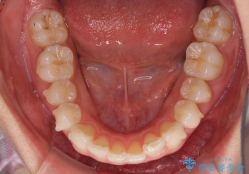 矯正治療の後戻りをインビザライン・ライトで改善の治療中