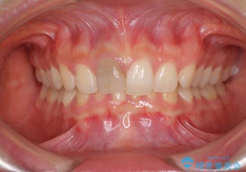 ぶつけて変色した前歯　オーダーメイドタイプのオールセラミッククラウンの治療前