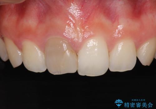ぶつけて変色した前歯 オーダーメイドタイプのオールセラミッククラウンの治療前
