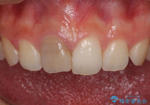 ぶつけて変色した前歯 オーダーメイドタイプのオールセラミッククラウンの治療前