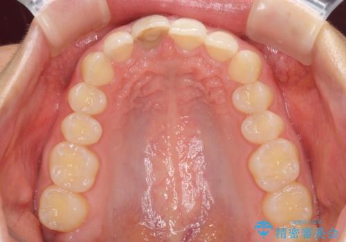 ぶつけて変色した前歯 オーダーメイドタイプのオールセラミッククラウンの治療前