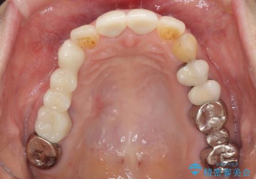 歯肉の縁に金属が見えて気になる　オールセラミッククラウンによる審美歯科治療の治療前
