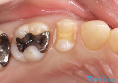 笑ったら銀歯が見える。 セラミックインレーによる治療の治療中