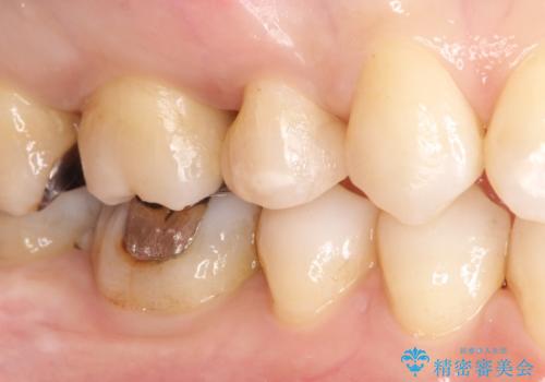 笑ったら銀歯が見える。 セラミックインレーによる治療の治療後