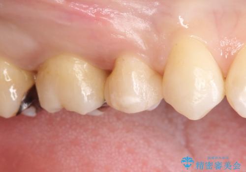 笑ったら銀歯が見える。 セラミックインレーによる治療の治療後