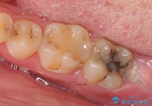 歯冠長延長術を併用した審美的セラミック治療の症例 治療前