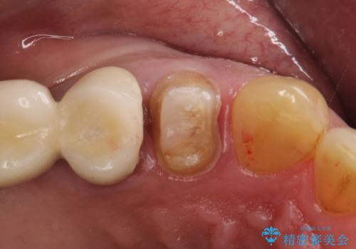 拡大鏡にて虫歯を除去。精度の高いセラミッククラウンの治療中