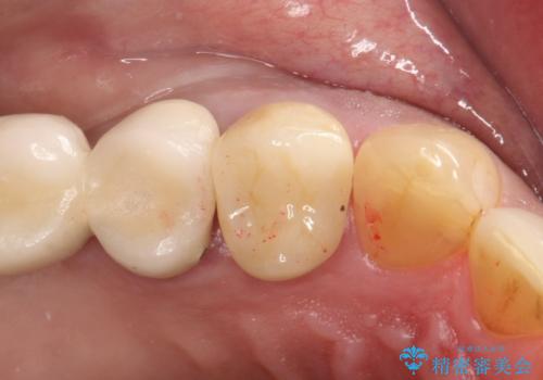拡大鏡にて虫歯を除去。精度の高いセラミッククラウンの症例 治療後