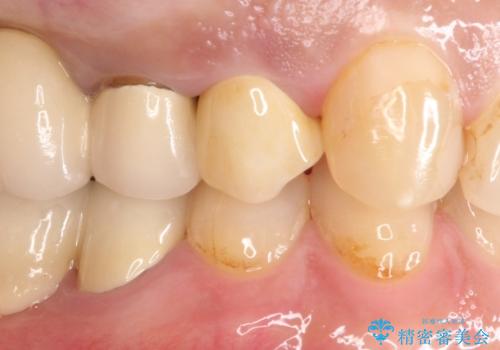 拡大鏡にて虫歯を除去。精度の高いセラミッククラウンの治療後