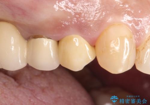 拡大鏡にて虫歯を除去。精度の高いセラミッククラウンの治療後
