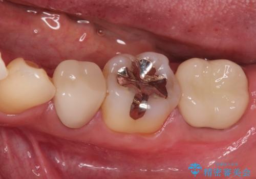 奥歯が痛い。根管治療からセラミッククラウンの治療後