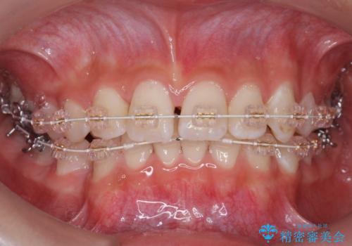 埋まっている犬歯を抜歯して、歯列矯正の治療中