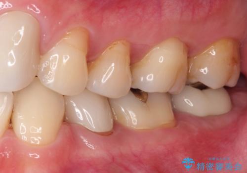 奥歯が痛い。根管治療からセラミッククラウンの治療後