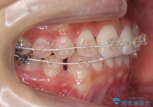 埋まっている犬歯を抜歯して、歯列矯正の治療中