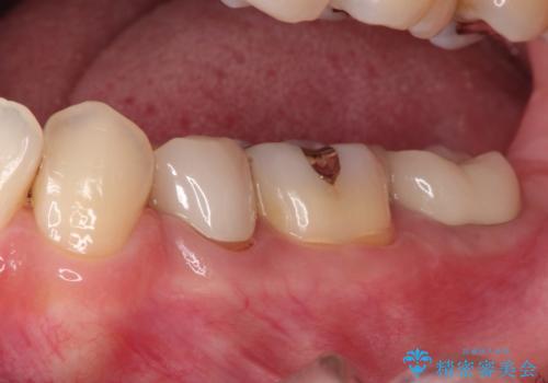 奥歯が痛い。根管治療からセラミッククラウンの治療後