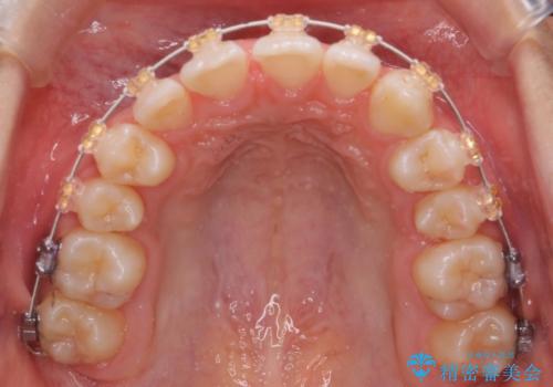 埋まっている犬歯を抜歯して、歯列矯正の治療中
