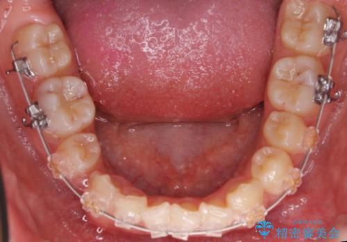 埋まっている犬歯を抜歯して、歯列矯正の治療中