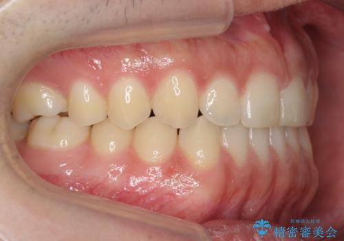前歯のすきま　受け口　インビザラインでの治療後