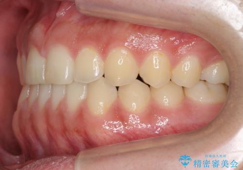 前歯のすきま 受け口 インビザラインでの治療後