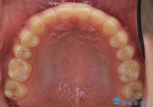 前歯のすきま 受け口 インビザラインでの治療後