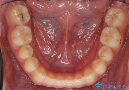 前歯のすきま 受け口 インビザラインでの治療後