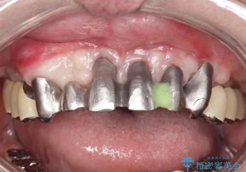 歯周病におかされた前歯の再建治療の治療中
