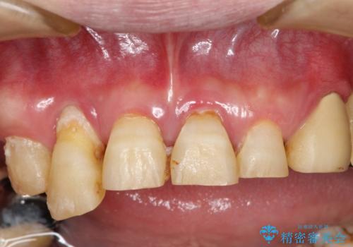 歯周病におかされた前歯の再建治療の症例 治療前