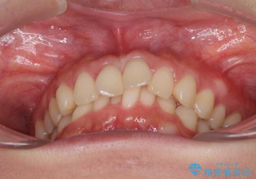 インビザラインによるディープバイトの改善の治療前