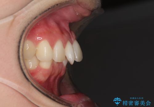インビザラインによるディープバイトの改善の治療前