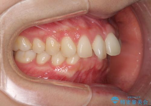 インビザラインによるディープバイトの改善の治療前
