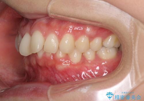 インビザラインによるディープバイトの改善の治療前