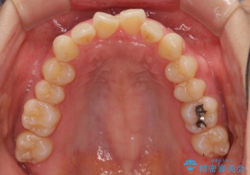 インビザラインによるディープバイトの改善の治療前