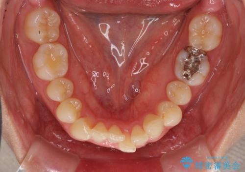 インビザラインによるディープバイトの改善の治療前