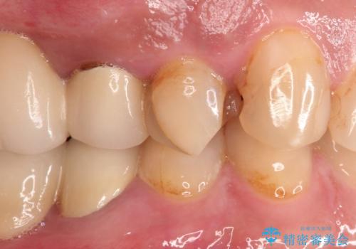 拡大鏡にて虫歯を除去。精度の高いセラミッククラウンの治療前