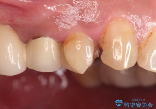 拡大鏡にて虫歯を除去。精度の高いセラミッククラウンの治療前