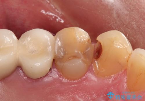 拡大鏡にて虫歯を除去。精度の高いセラミッククラウンの治療前