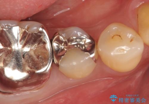 PGA(ゴールド)インレー　しみる歯の治療の症例 治療前