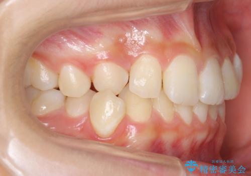 埋まっている犬歯を抜歯して、歯列矯正の治療前