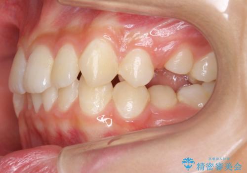 埋まっている犬歯を抜歯して、歯列矯正の治療前