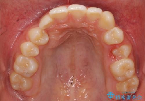 埋まっている犬歯を抜歯して、歯列矯正の治療前